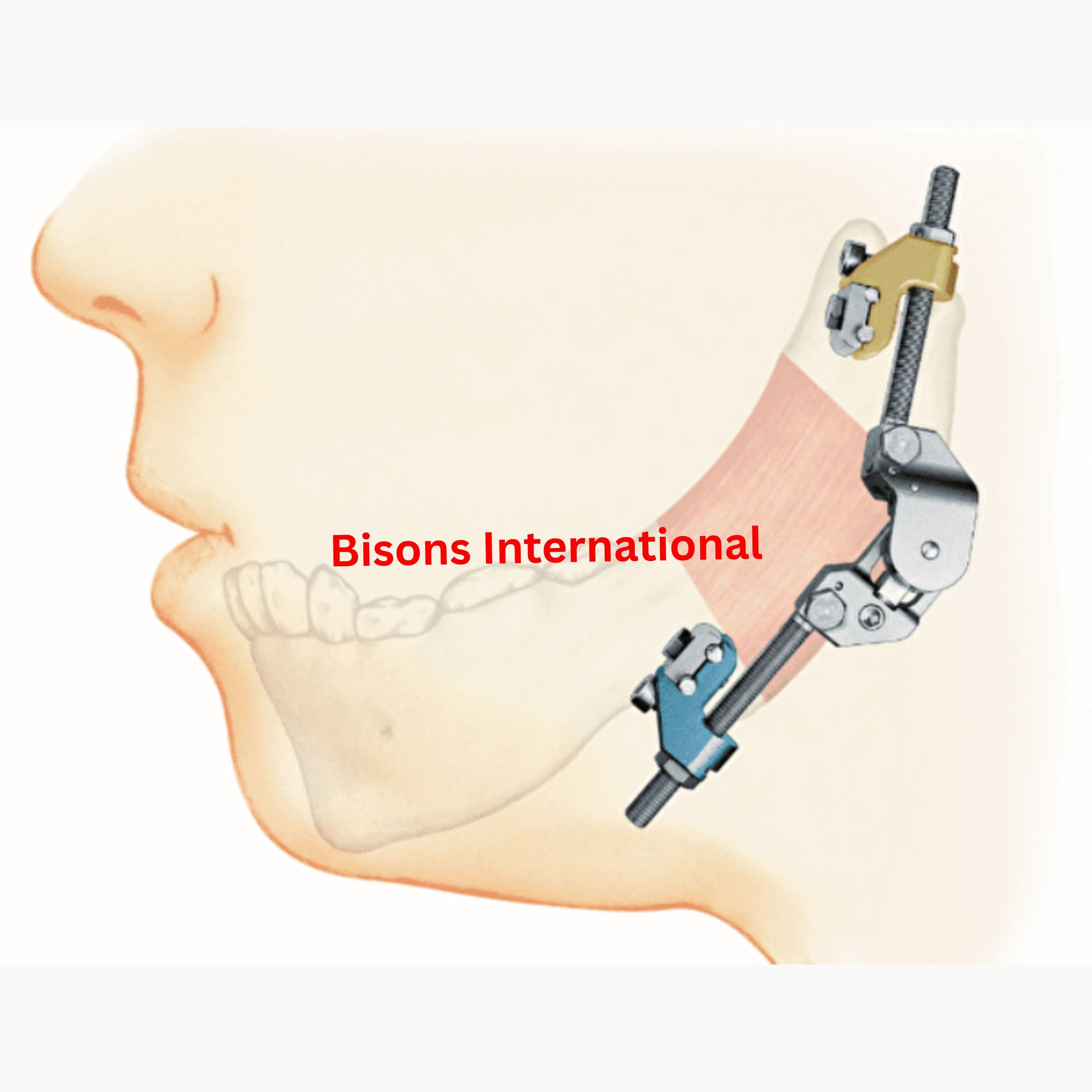 Titanium Multi-Vector Bone Distractor for Craniofacial Surgery