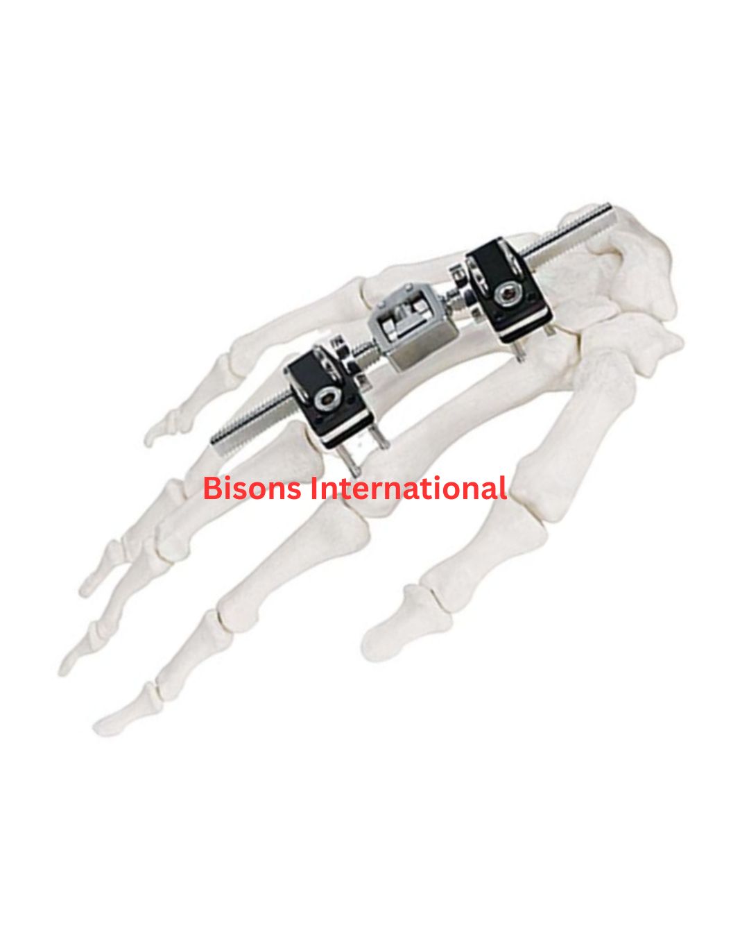 Orthopedic Mini External Fixator for Finger and Palm Fracture Stabilization